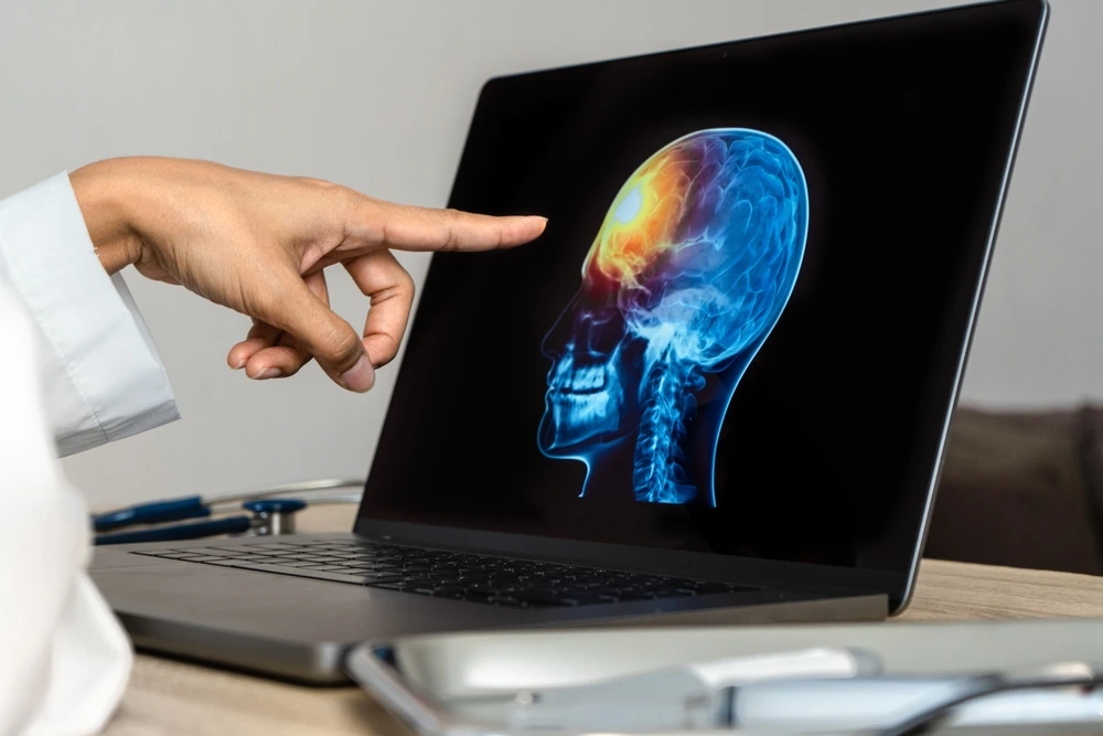 Close up of doctor looking a x-ray of pain in the brain on a laptop. catastrophic traumatic brain injuries.